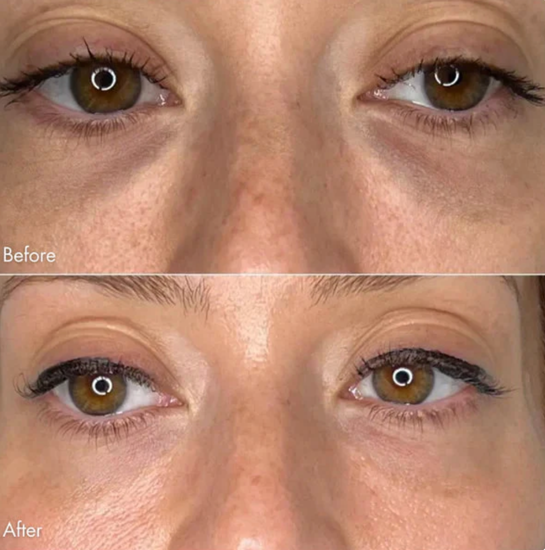 Microneedling Eye Patches