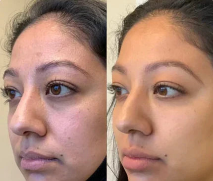 Microneedling Eye Patches