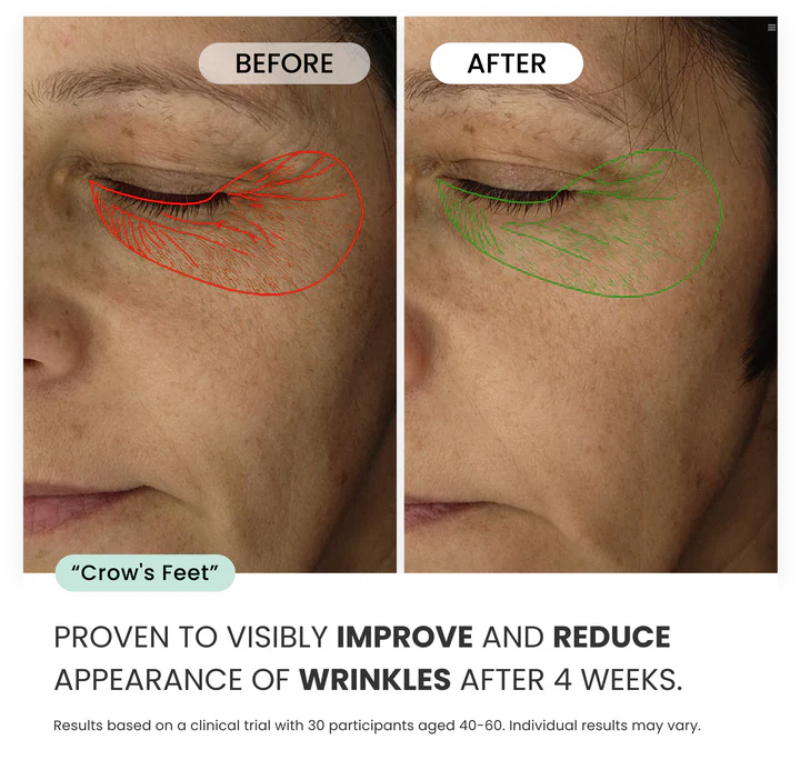 Microneedling Eye Patches