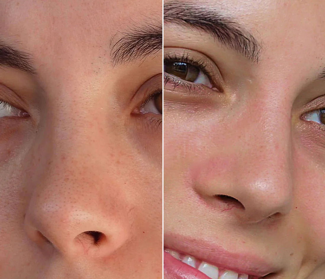 Acne Nose Patch