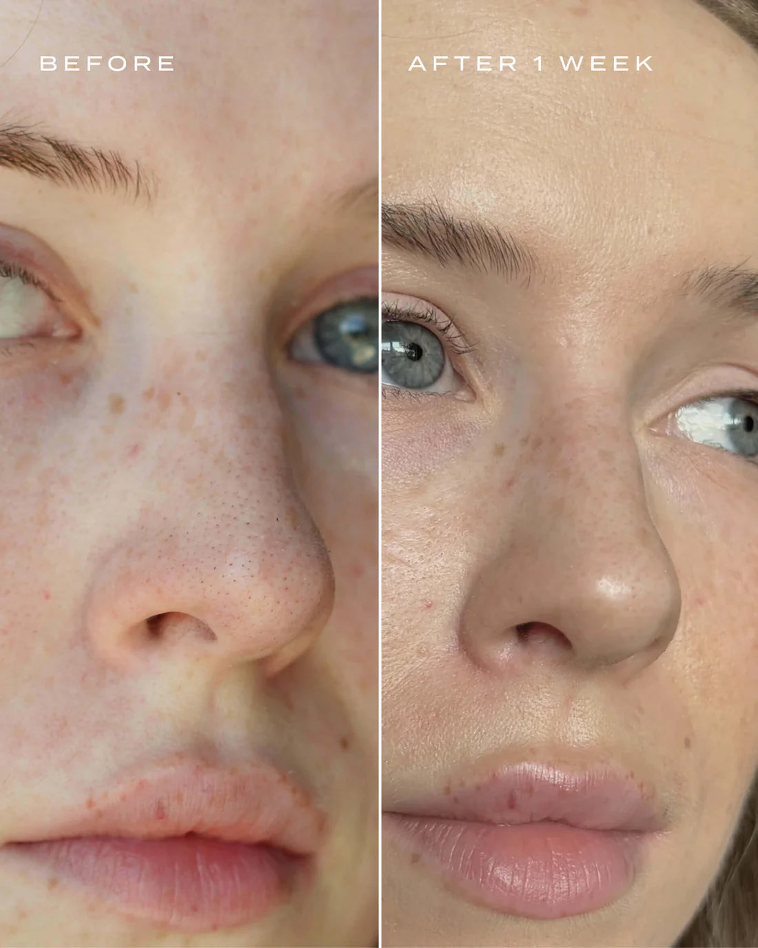 Acne Nose Patch