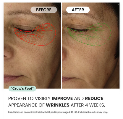 Microneedling Eye Patches