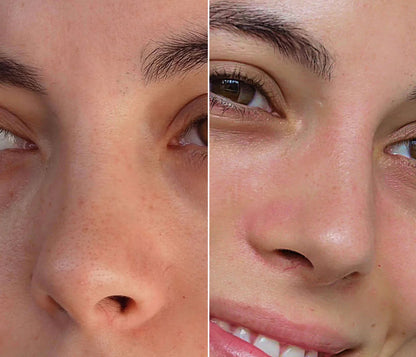 Acne Nose Patch